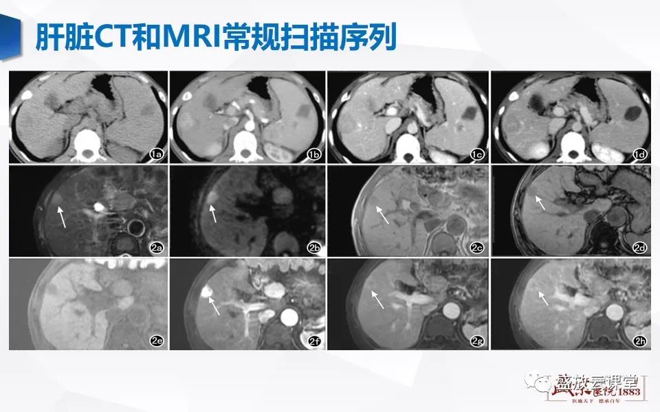 影像PPT - 【PPT】肝硬化结节MR评估-3