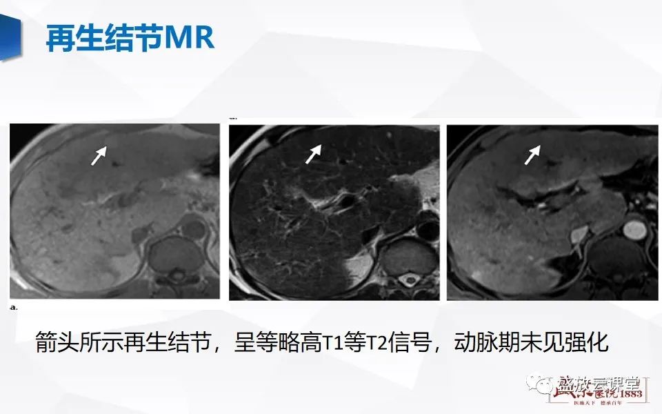 影像PPT - 【PPT】肝硬化结节MR评估-7
