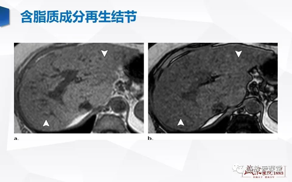 影像PPT - 【PPT】肝硬化结节MR评估-8