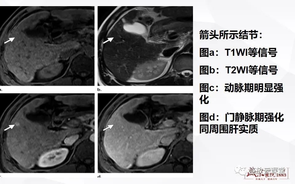 影像PPT - 【PPT】肝硬化结节MR评估-11