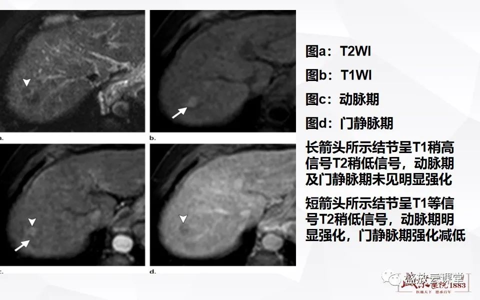 影像PPT - 【PPT】肝硬化结节MR评估-13