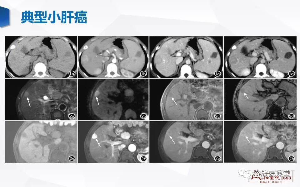 影像PPT - 【PPT】肝硬化结节MR评估-16