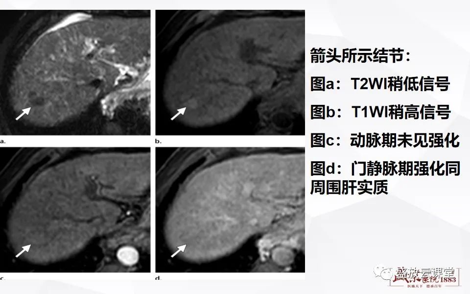 影像PPT - 【PPT】肝硬化结节MR评估-12