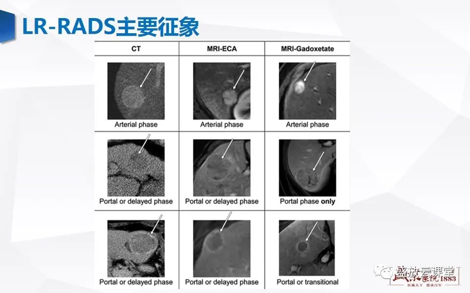 影像PPT - 【PPT】肝硬化结节MR评估-21