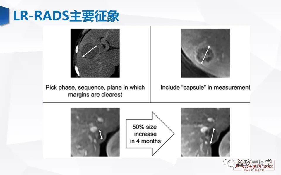 影像PPT - 【PPT】肝硬化结节MR评估-22