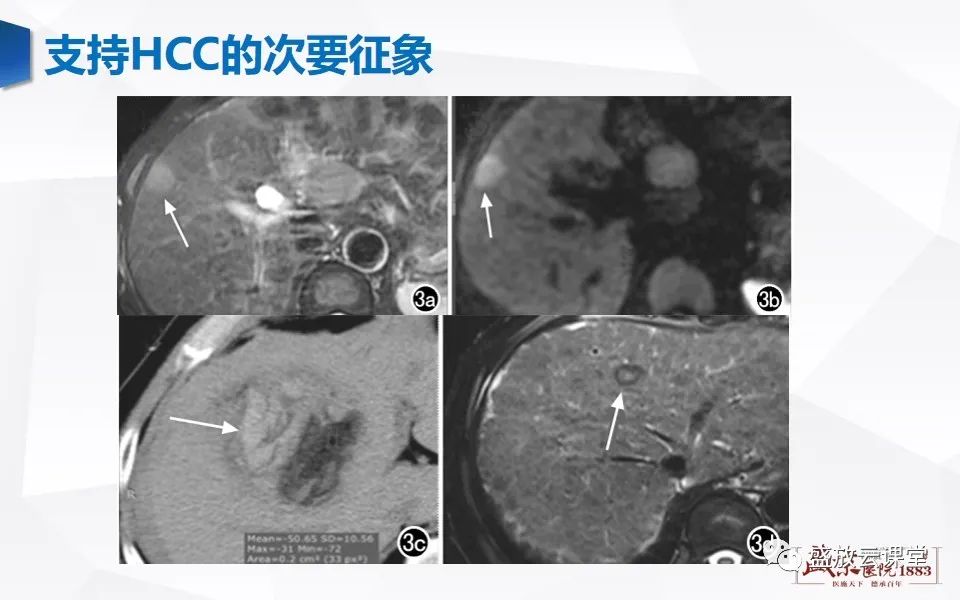 影像PPT - 【PPT】肝硬化结节MR评估-25