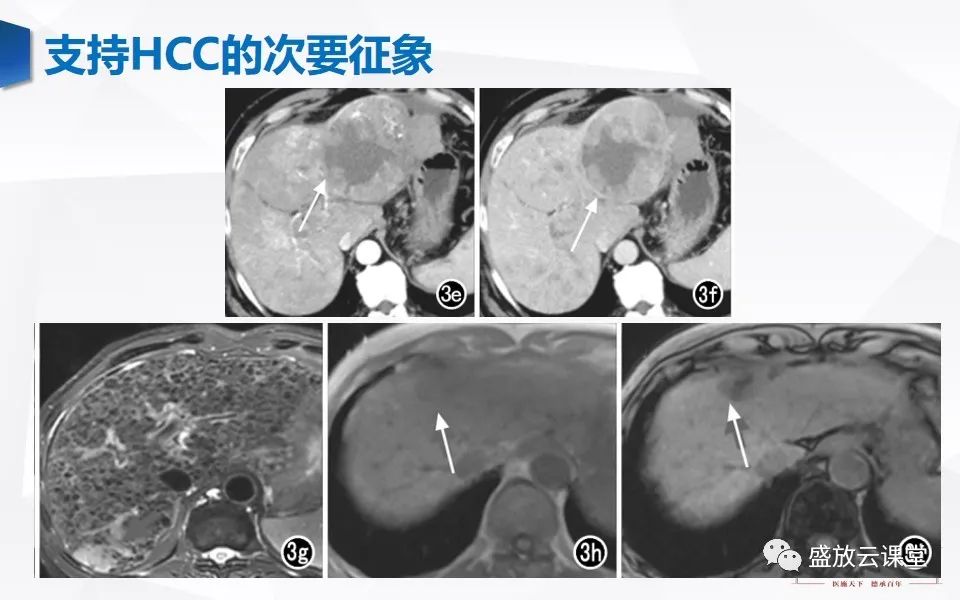影像PPT - 【PPT】肝硬化结节MR评估-26
