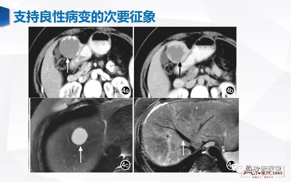 影像PPT - 【PPT】肝硬化结节MR评估-28