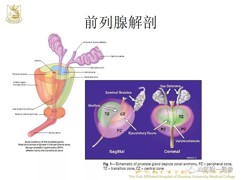影像PPT - 【PPT】前列腺囊肿的影像诊断-3
