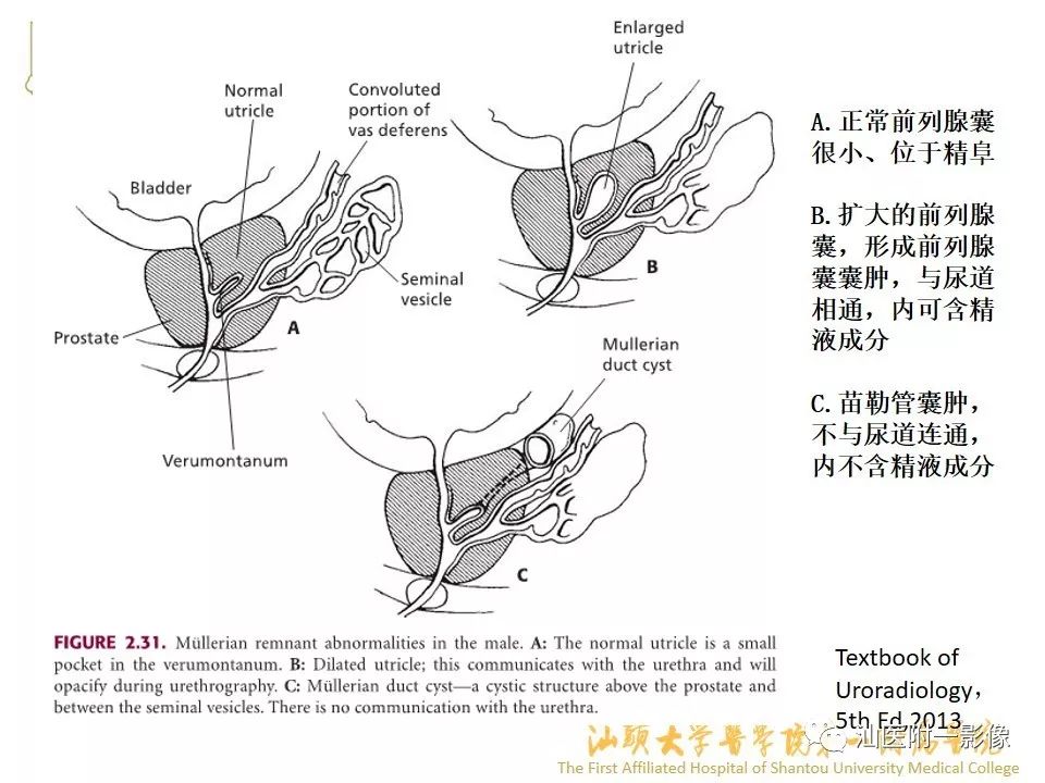 影像PPT - 【PPT】前列腺囊肿的影像诊断-8