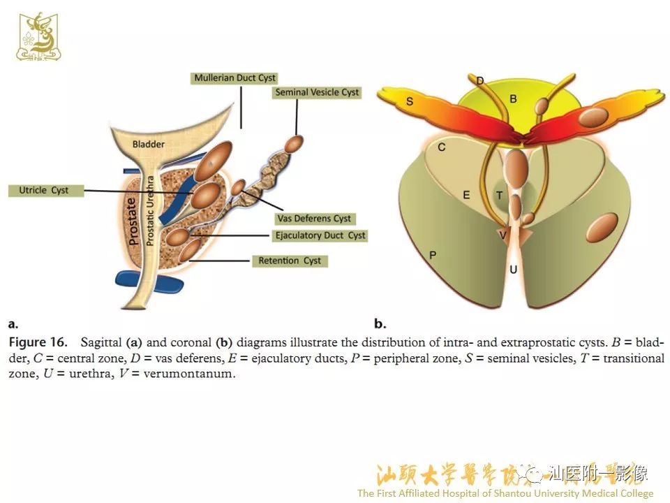 影像PPT - 【PPT】前列腺囊肿的影像诊断-11