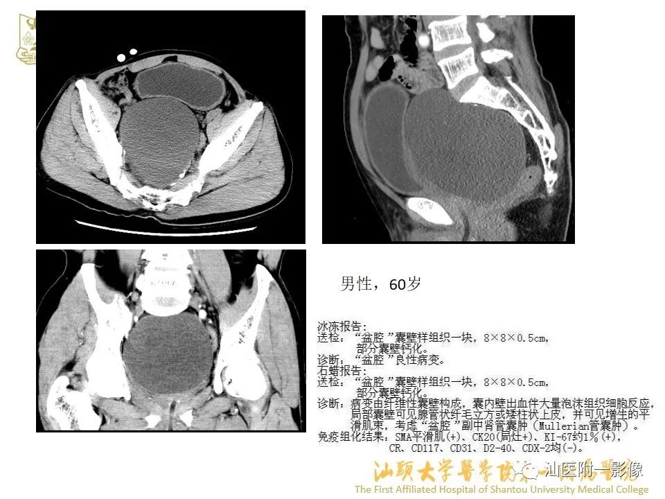 影像PPT - 【PPT】前列腺囊肿的影像诊断-19