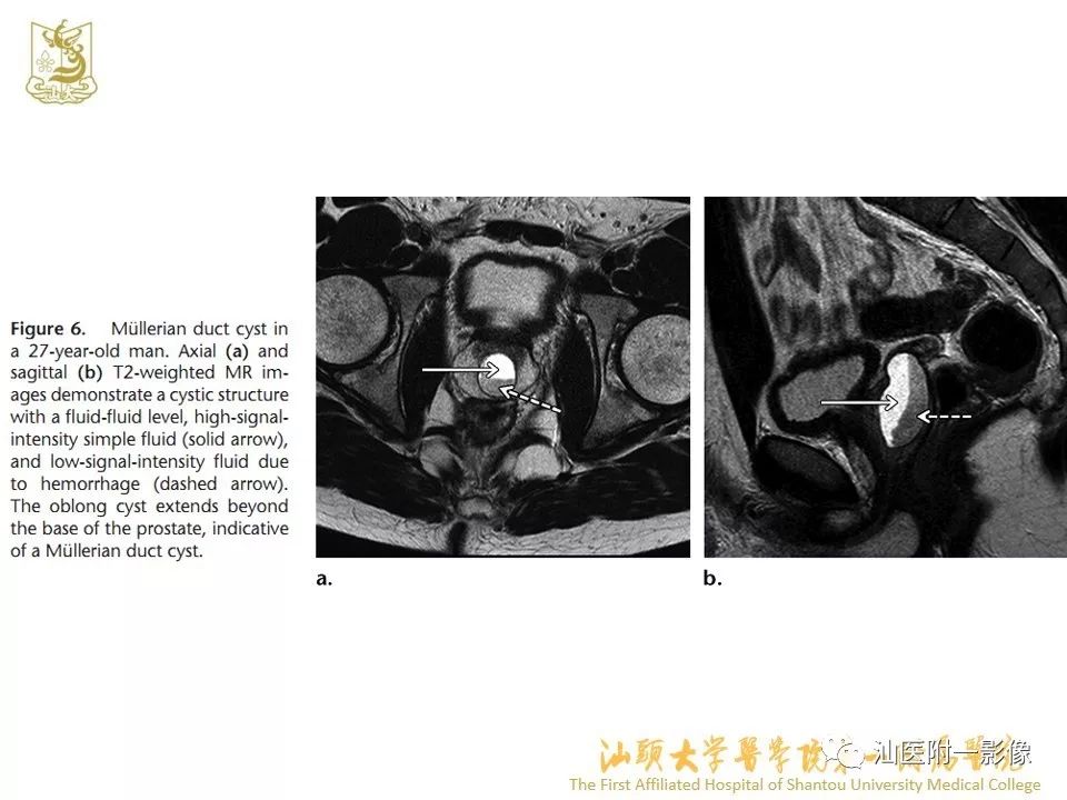 影像PPT - 【PPT】前列腺囊肿的影像诊断-21