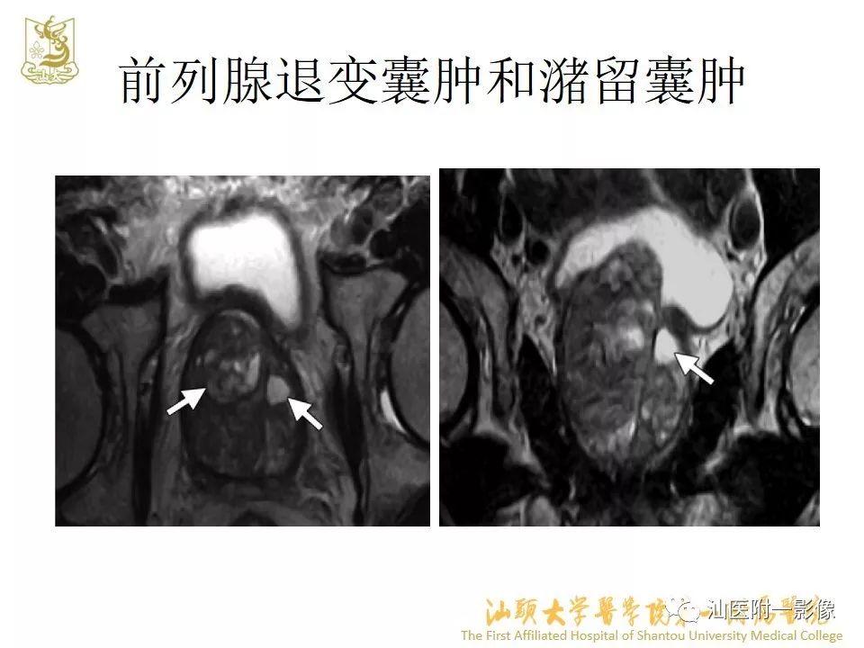 影像PPT - 【PPT】前列腺囊肿的影像诊断-25