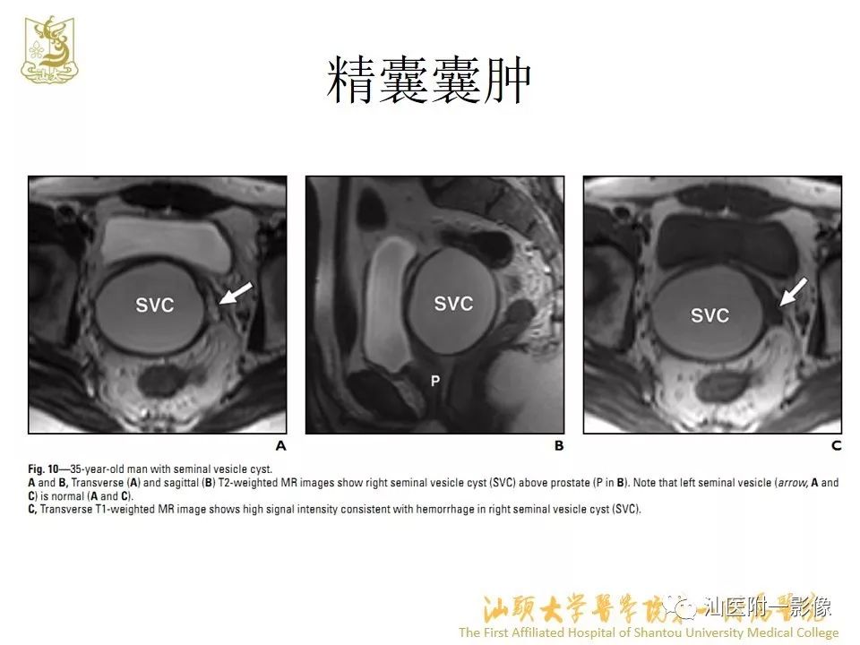 影像PPT - 【PPT】前列腺囊肿的影像诊断-28
