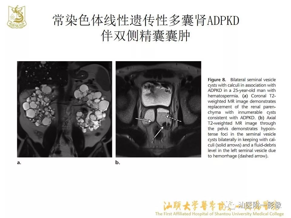 影像PPT - 【PPT】前列腺囊肿的影像诊断-29
