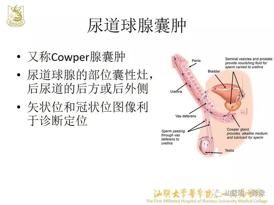 影像PPT - 【PPT】前列腺囊肿的影像诊断-32