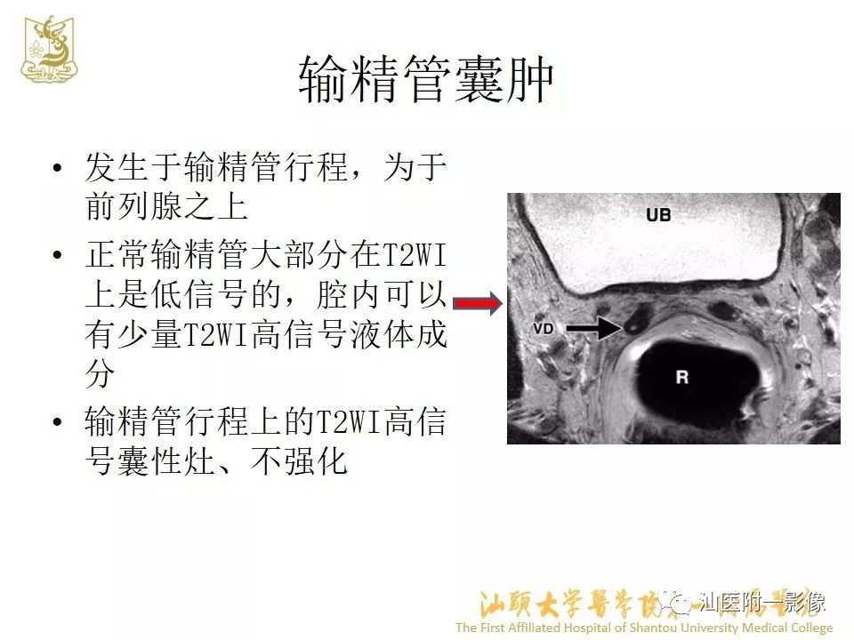 影像PPT - 【PPT】前列腺囊肿的影像诊断-30