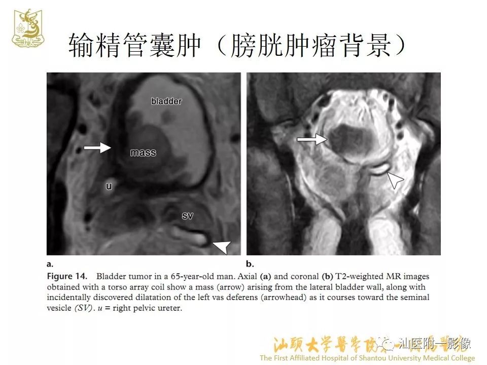 影像PPT - 【PPT】前列腺囊肿的影像诊断-31