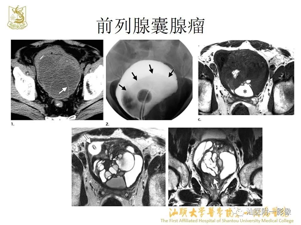 影像PPT - 【PPT】前列腺囊肿的影像诊断-36