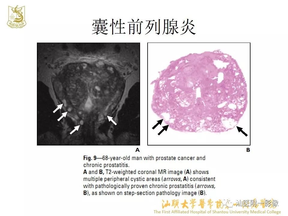 影像PPT - 【PPT】前列腺囊肿的影像诊断-38