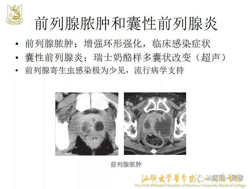 影像PPT - 【PPT】前列腺囊肿的影像诊断-37