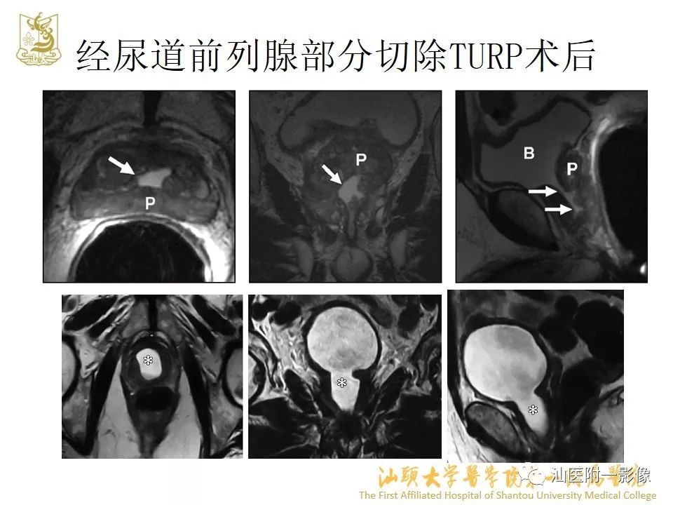 影像PPT - 【PPT】前列腺囊肿的影像诊断-39