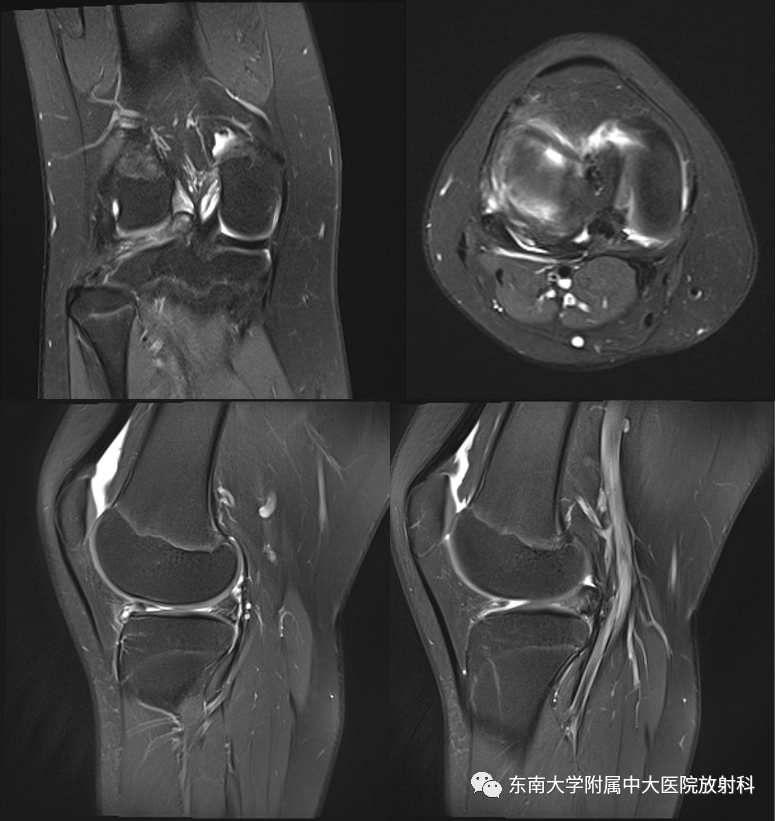 影像PPT - 【PPT】膝关节半月板解剖及常见诊断误区-1