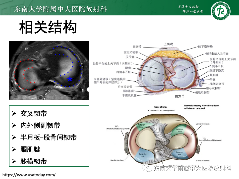 影像PPT - 【PPT】膝关节半月板解剖及常见诊断误区-6