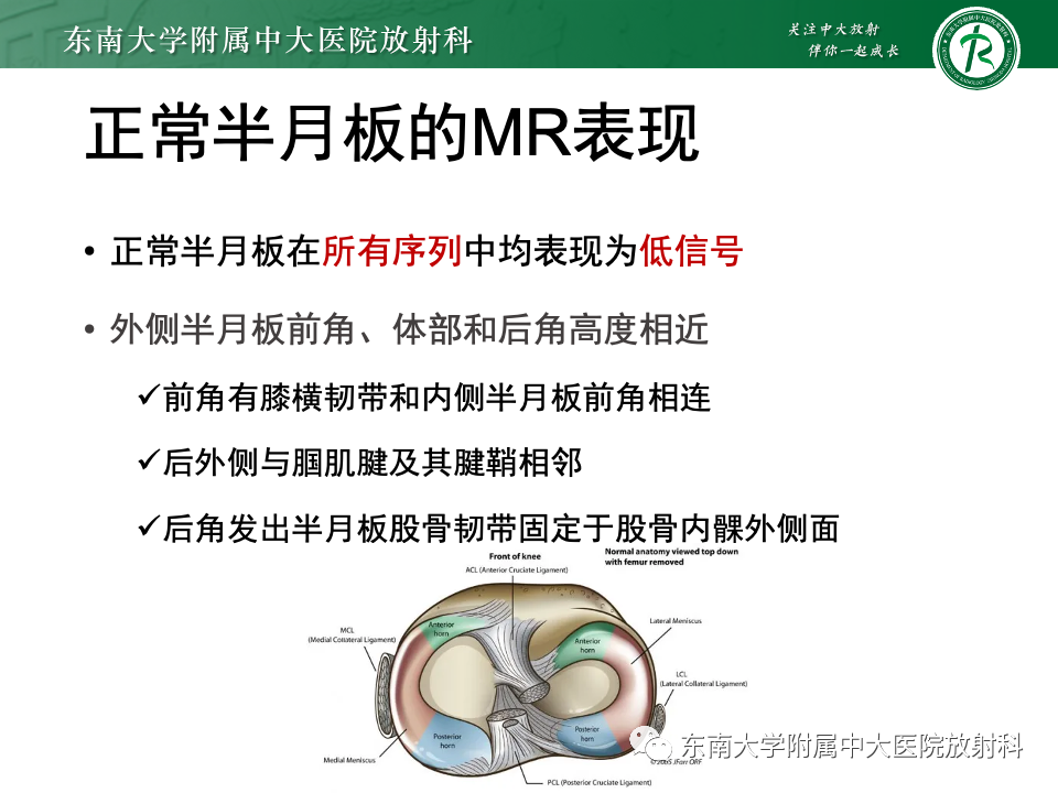 影像PPT - 【PPT】膝关节半月板解剖及常见诊断误区-7
