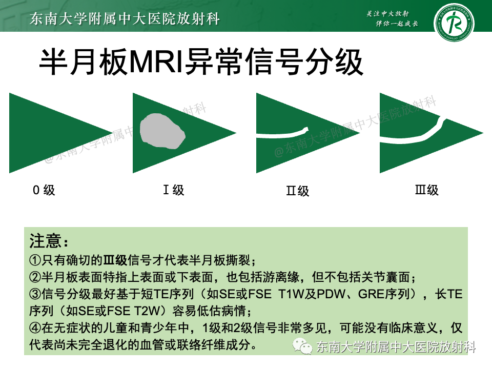 影像PPT - 【PPT】膝关节半月板解剖及常见诊断误区-10