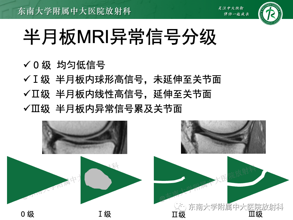 影像PPT - 【PPT】膝关节半月板解剖及常见诊断误区-9