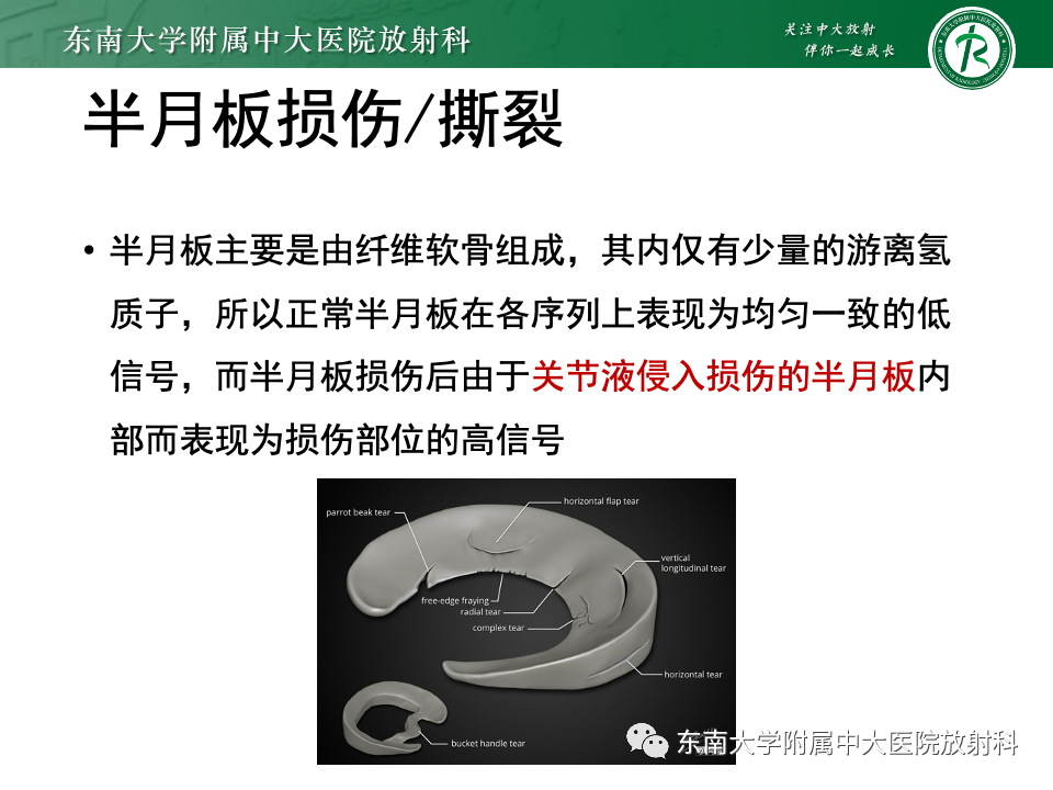 影像PPT - 【PPT】膝关节半月板解剖及常见诊断误区-8