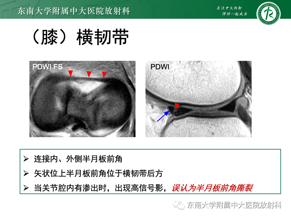 影像PPT - 【PPT】膝关节半月板解剖及常见诊断误区-13
