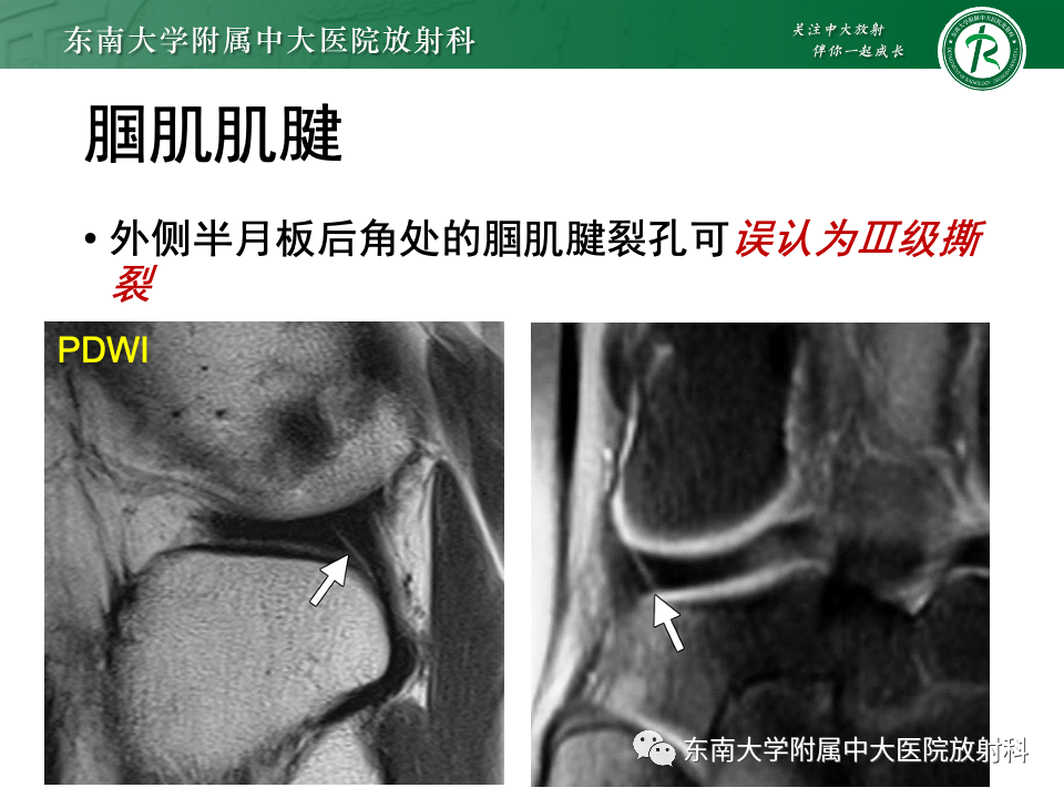 影像PPT - 【PPT】膝关节半月板解剖及常见诊断误区-14