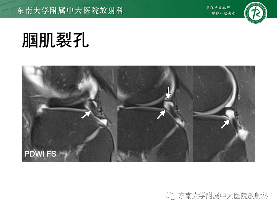 影像PPT - 【PPT】膝关节半月板解剖及常见诊断误区-15