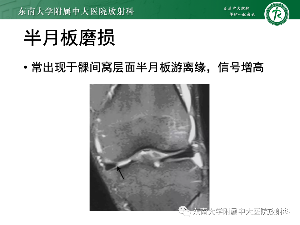 影像PPT - 【PPT】膝关节半月板解剖及常见诊断误区-17