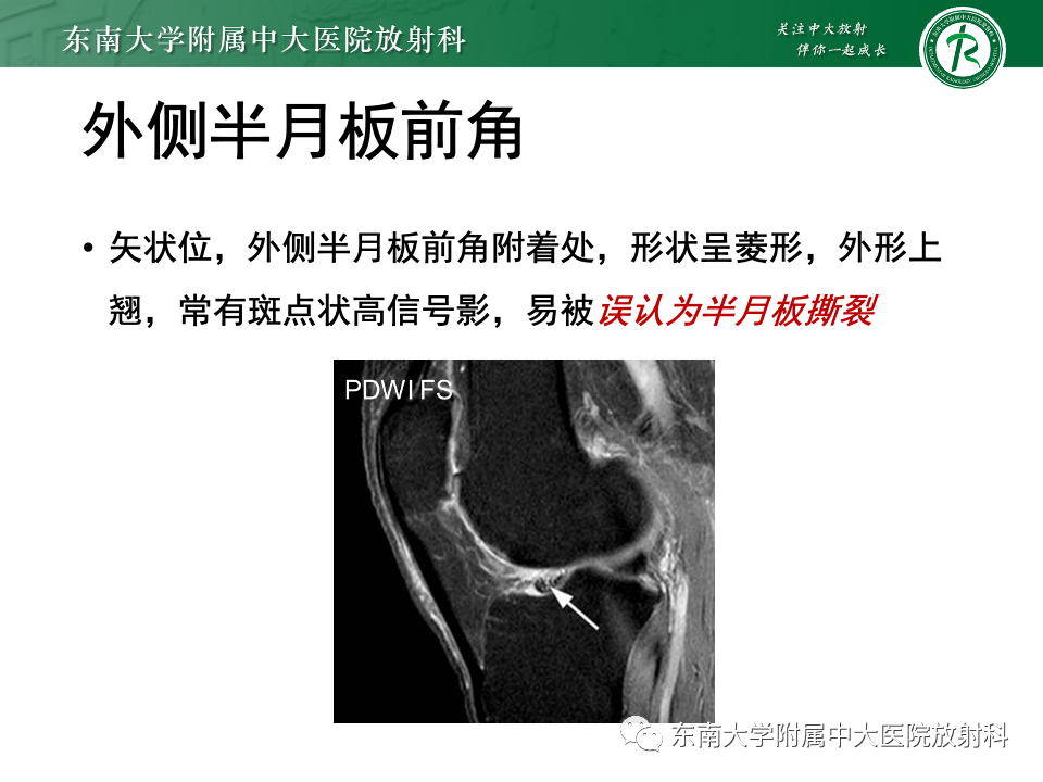 影像PPT - 【PPT】膝关节半月板解剖及常见诊断误区-16