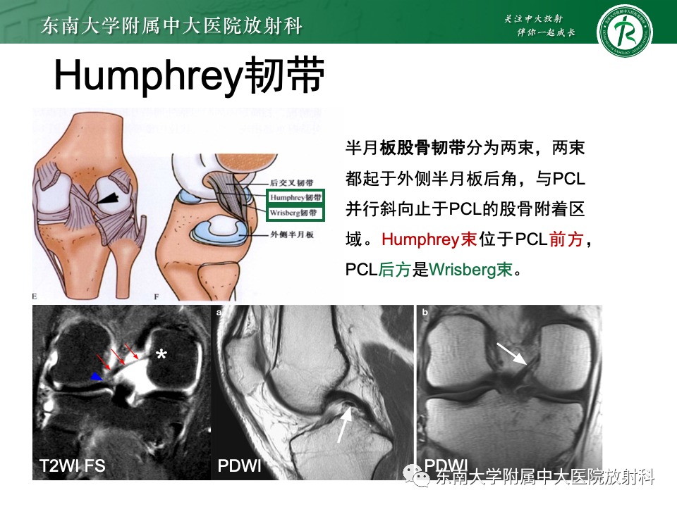 影像PPT - 【PPT】膝关节半月板解剖及常见诊断误区-18
