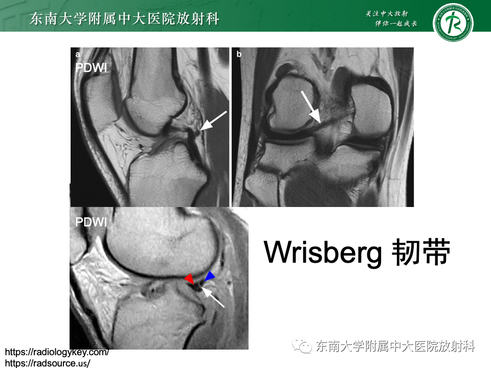 影像PPT - 【PPT】膝关节半月板解剖及常见诊断误区-19