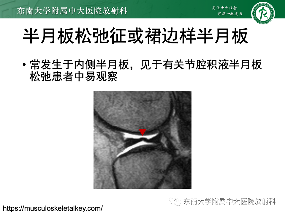 影像PPT - 【PPT】膝关节半月板解剖及常见诊断误区-22