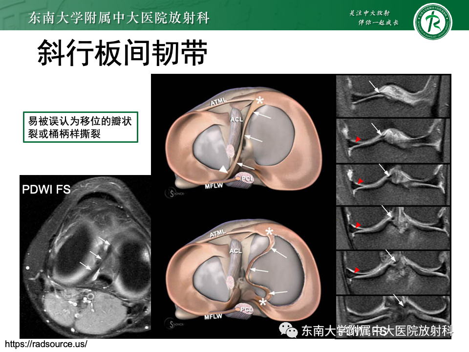 影像PPT - 【PPT】膝关节半月板解剖及常见诊断误区-21