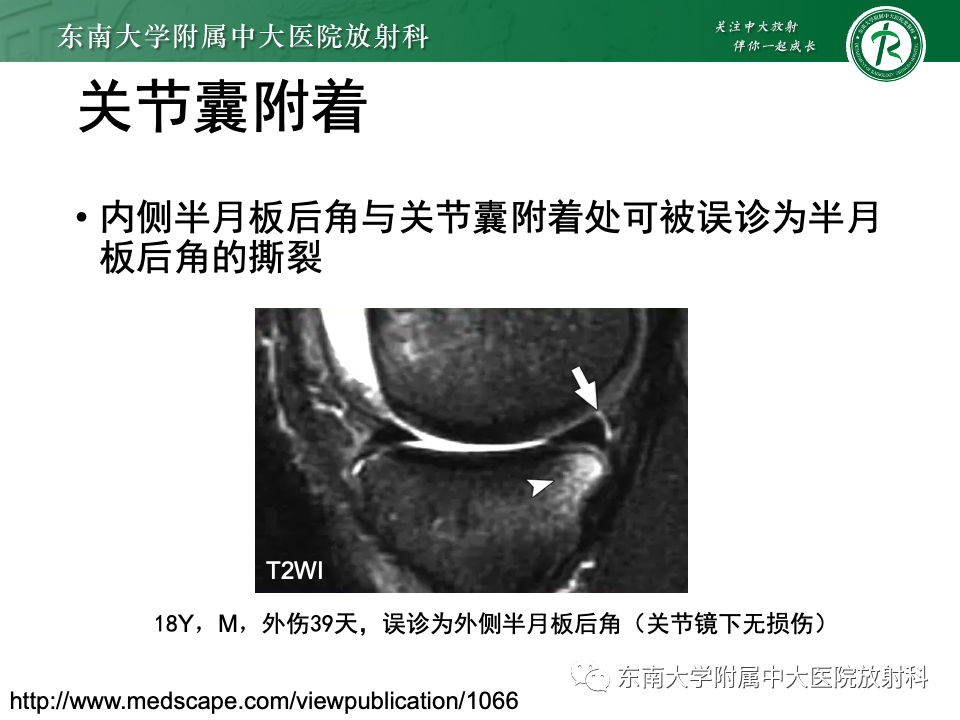 影像PPT - 【PPT】膝关节半月板解剖及常见诊断误区-24