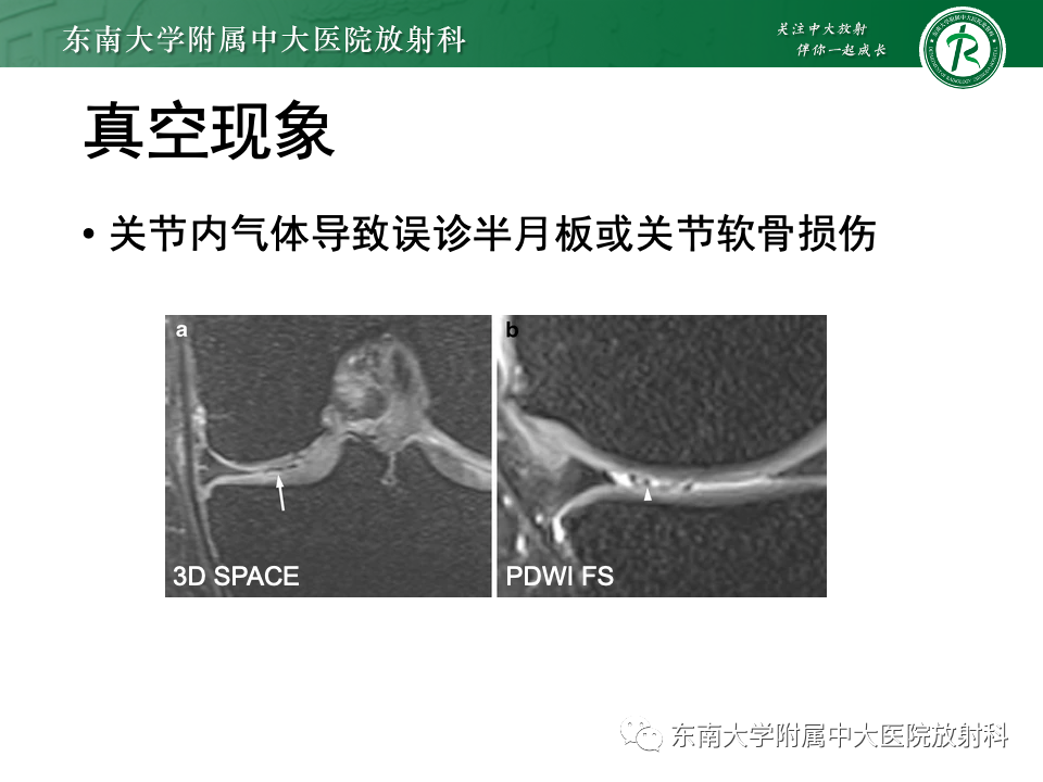 影像PPT - 【PPT】膝关节半月板解剖及常见诊断误区-23