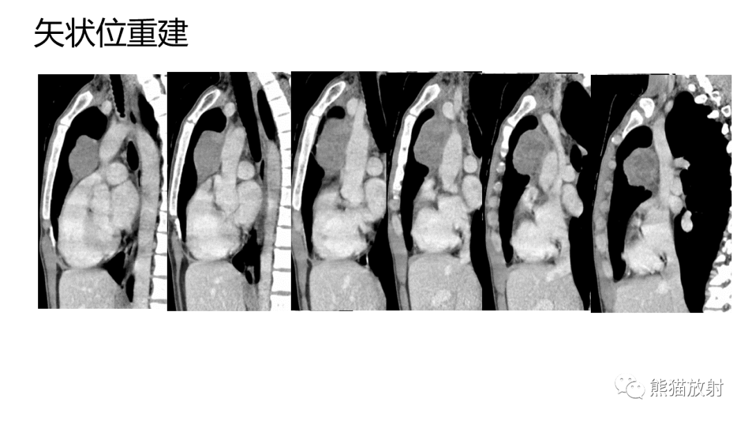 影像PPT - 【病例】纵隔淋巴瘤 VS 胸腺癌-8