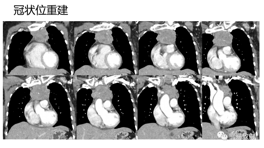 影像PPT - 【病例】纵隔淋巴瘤 VS 胸腺癌-16