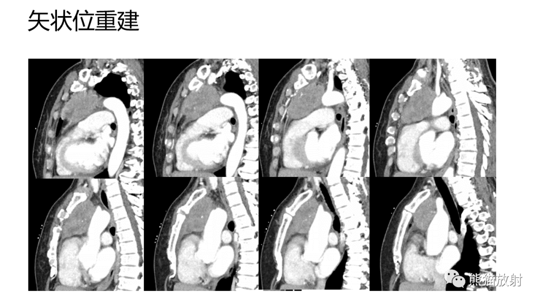 影像PPT - 【病例】纵隔淋巴瘤 VS 胸腺癌-17
