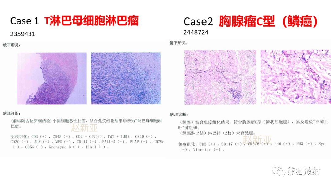 影像PPT - 【病例】纵隔淋巴瘤 VS 胸腺癌-20