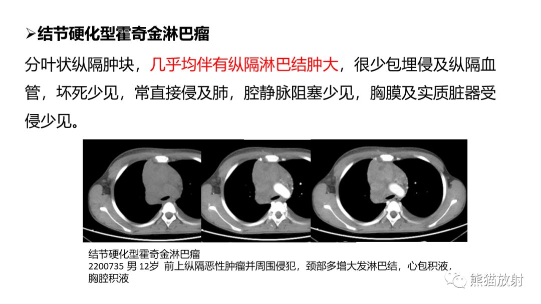 影像PPT - 【病例】纵隔淋巴瘤 VS 胸腺癌-25