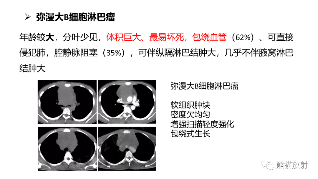 影像PPT - 【病例】纵隔淋巴瘤 VS 胸腺癌-26